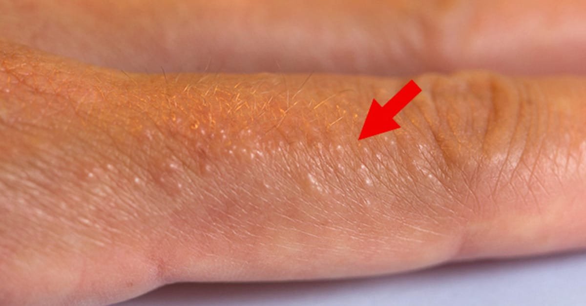 If You See These Painful Red Bumps, You May Have Dyshidrotic Eczema ...